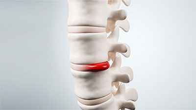 patient needs herniated disc chiropractor in Dublin CA