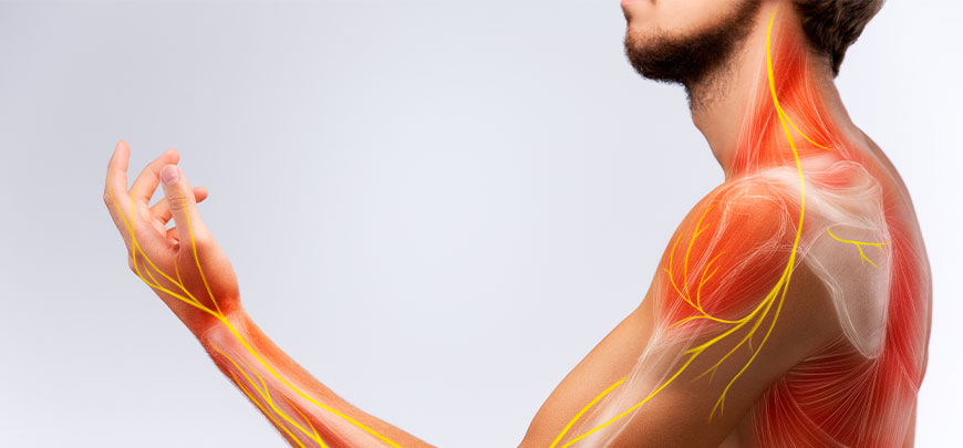 patient needing brachial plexus neuritis treatment in Dublin