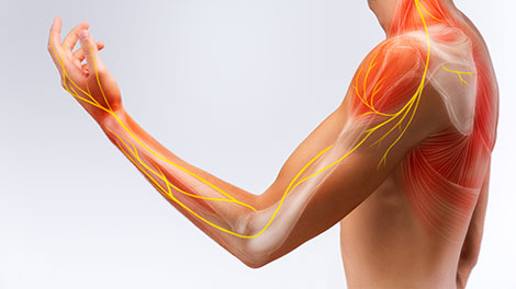 patient requiring brachial plexus neuritis treatment in Dublin