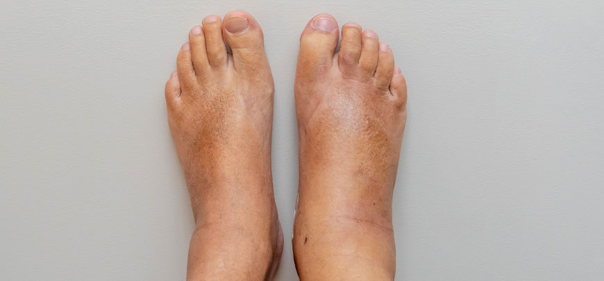 patient needing complex regional pain syndrome treatment in Dublin