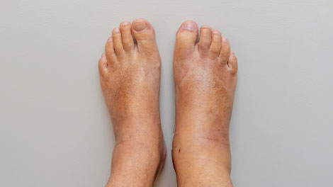 patient requiring complex regional pain syndrome treatment in Dublin