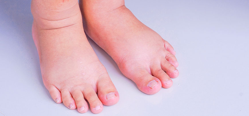 patient needing diabetic neuropathy treatment in Dublin