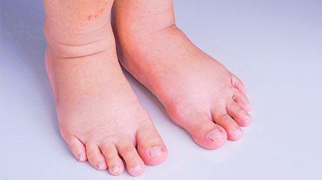 patient requiring diabetic neuropathy treatment in Dublin