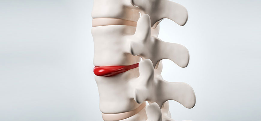 patient needing herniated disc treatment in Dublin