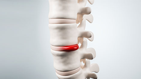 patient requiring disc injury treatment in Dublin