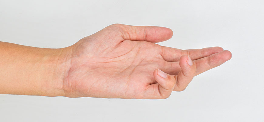 patient needing dupuytren contracture treatment in Dublin
