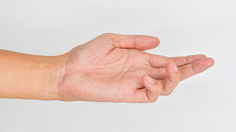 patient requiring dupuytren contracture treatment in Dublin