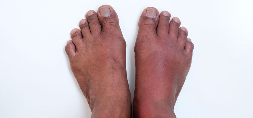 patient needing peripheral neuropathy treatment in Dublin