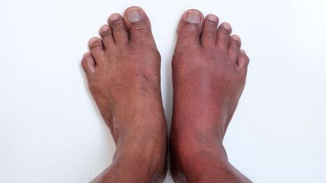 patient requiring peripheral neuropathy treatment in Dublin