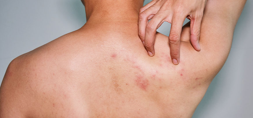 patient needing post-herpetic neuralgia treatment in Dublin