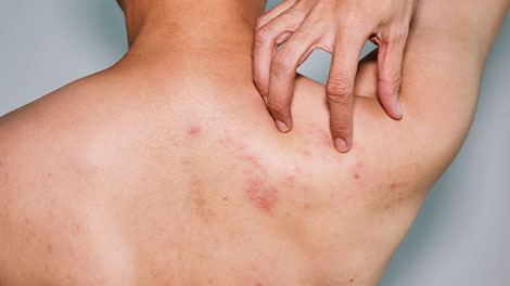 patient requiring post herpetic neuralgia treatment in Dublin