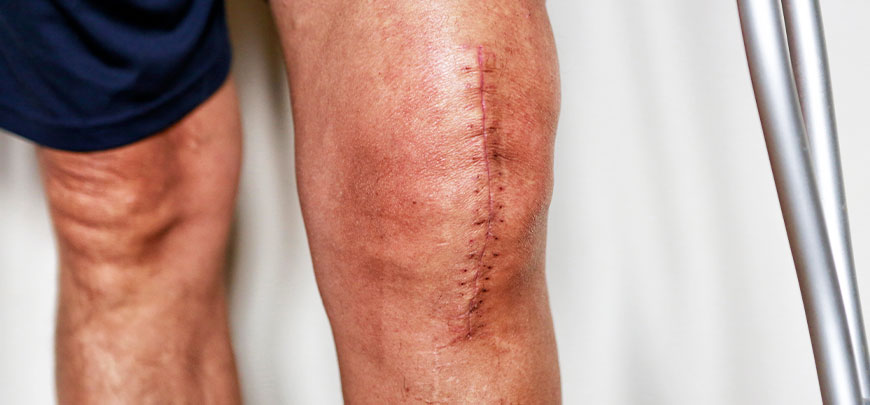 patient needing post-surgical neuropathic pain treatment in Dublin