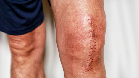 patient requiring post surgical neuropathic pain treatment in Dublin