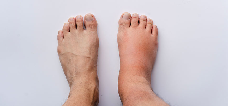 patient needing reflex sympathetic dystrophy treatment in Dublin