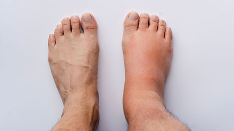 patient requiring reflex sympathetic dystrophy treatment in Dublin