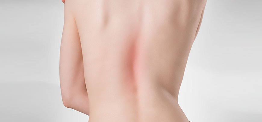 patient needing scoliosis treatment in Dublin