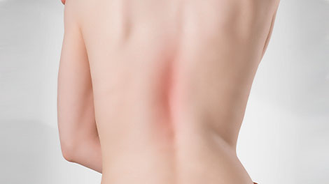 patient requiring scoliosis treatment in Dublin