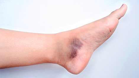 patient requiring sprain treatment in Dublin