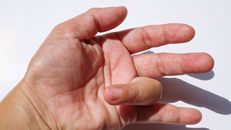 patient requiring trigger finger treatment in Dublin